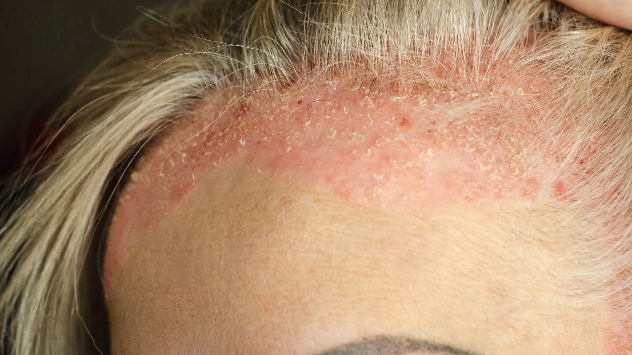 Psoriasis 1280.jpg