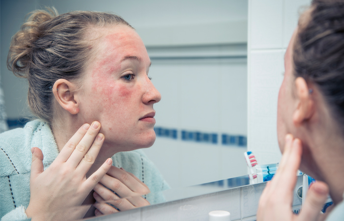 eczema_face_mirror.jpg