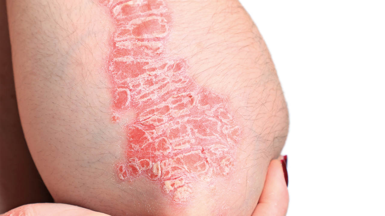 psoriasis-arm
