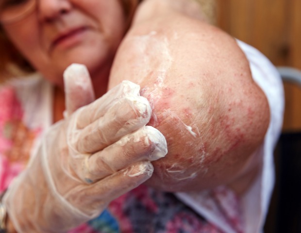 eczema-on-elbow-id513381545b.jpg