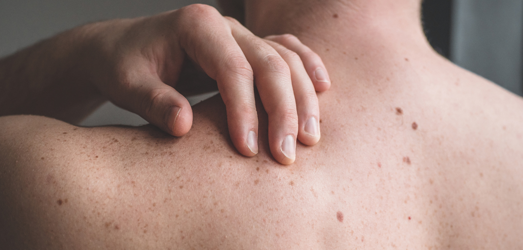 moles back_s.jpg