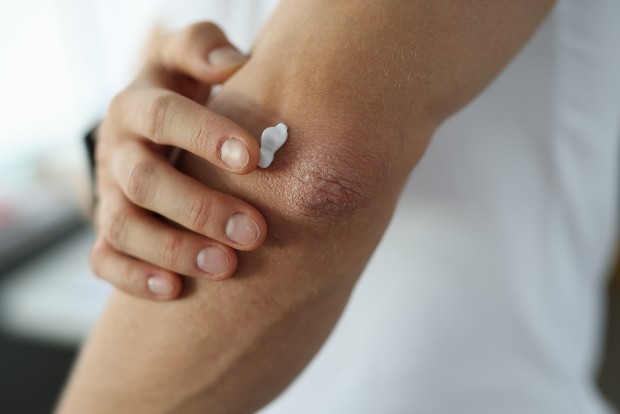 Psoriasis 620.jpg